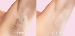 Underarm Laser Hair Removal