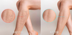 Leg Laser Hair Removal