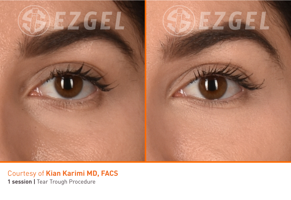 ezGEL before and after pictures.