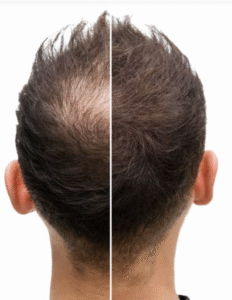 Hair Restoration